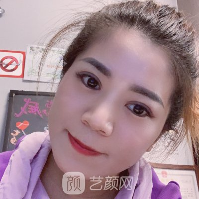 杭州格莱美张霞飞修复双眼皮怎么样?热门体验实例出炉