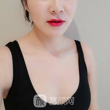 南京韩辰美容医院正规吗?20223隆胸实例曝光