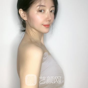 李健自体脂肪隆胸实例，胸部看起来立挺饱满，没有了紧绷感