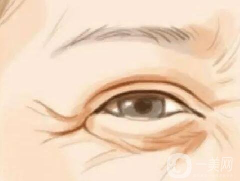激光去除鱼尾纹有什么好处？有什么原理？