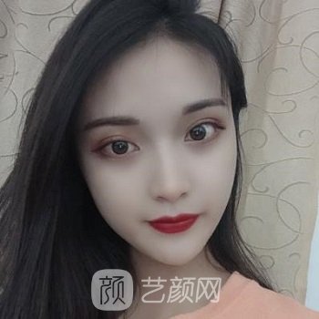 沈阳杏林房红超双眼皮实例，手术前后对比图照片