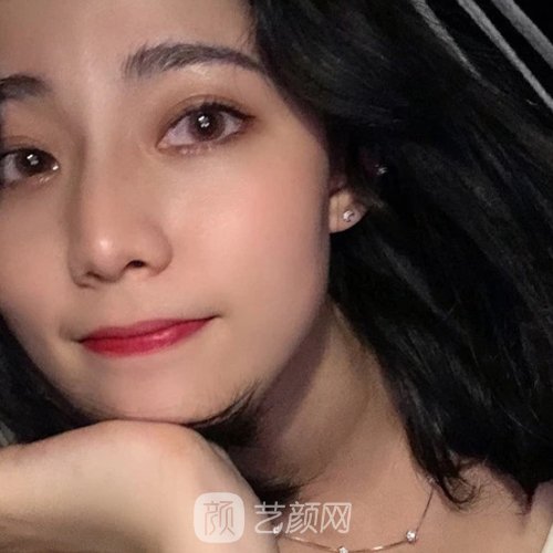 大连朗域整形医院怎么样？全新隆鼻实例出炉