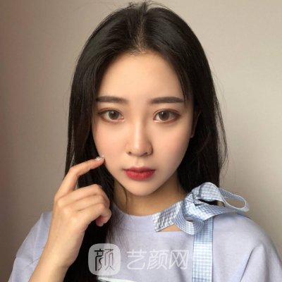 广东韩妃整形医院是三甲医院吗？2023玻尿酸填充实例发布