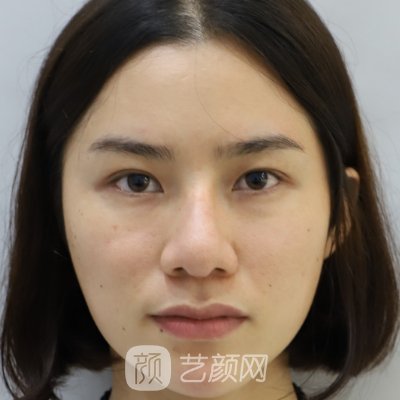 成都达芬奇医疗美容医院正规吗？2023隆鼻实例一览