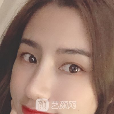 成都达芬奇医疗美容医院正规吗？2023隆鼻实例一览