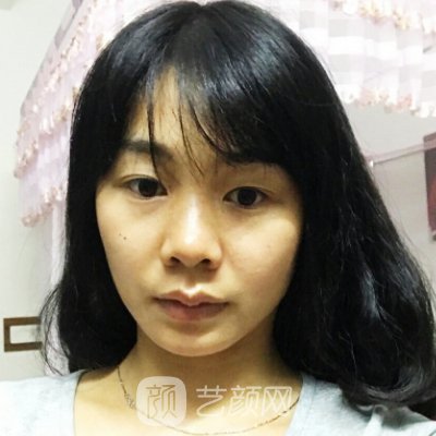 武汉五洲整形外科医院割双眼皮靠谱吗？70天体验细节展示