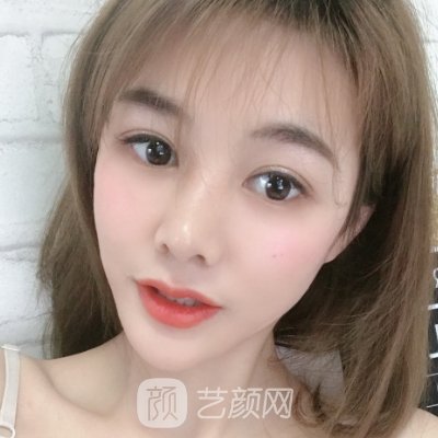 武汉五洲整形外科医院割双眼皮靠谱吗？70天体验细节展示