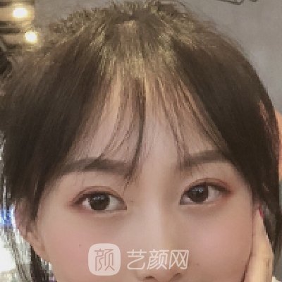 合肥智善美整形医院割双眼皮怎么样？成果有保护