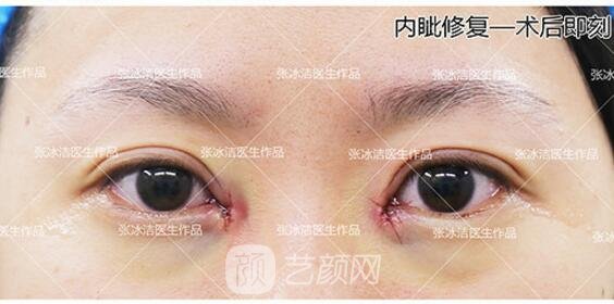 张冰洁修复眼角靠谱吗？医生简介+真人修复眼角实例图