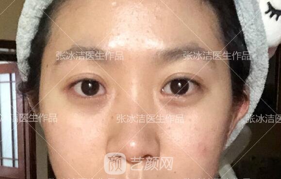 张冰洁修复眼角靠谱吗？医生简介+真人修复眼角实例图