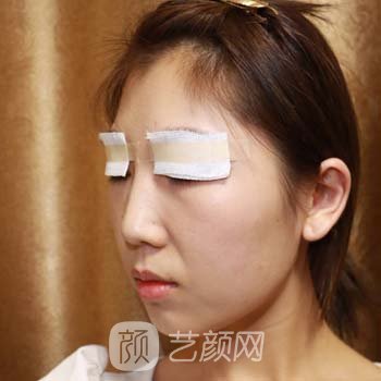 全切双眼皮7天修复图，修复期不变丑的秘密~