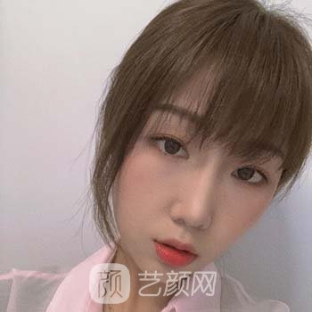 全切双眼皮7天修复图，修复期不变丑的秘密~