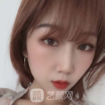全切双眼皮7天修复图，修复期不变丑的秘密~