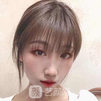 全切双眼皮7天修复图，修复期不变丑的秘密~