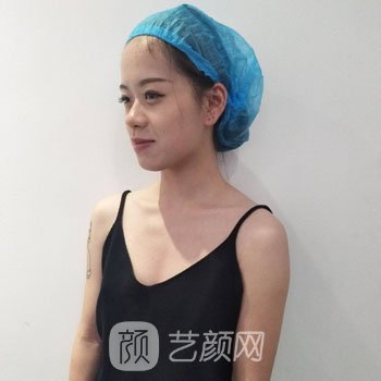 重庆刘怀朴做隆胸实例，术后让我拥有这么好看的胸部~