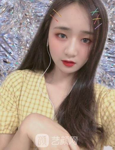 高占巍磨骨实例术后，面部线条变得流畅了，就像是鹅蛋脸一样