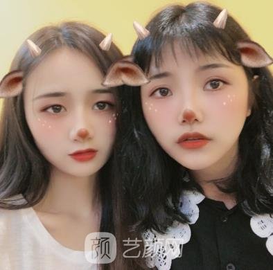 高占巍磨骨实例术后，面部线条变得流畅了，就像是鹅蛋脸一样