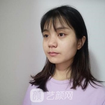 刘战辉隆鼻实例，术后鼻子高挺，颜值提升不少