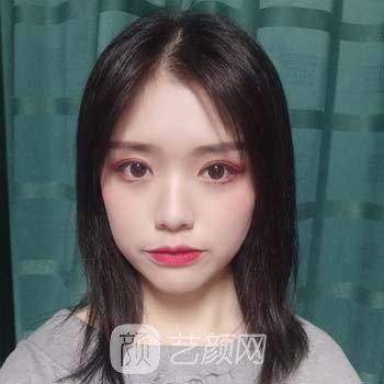 美神整形美容医院怎么样？骨干医生介绍双眼皮实例，附价目表