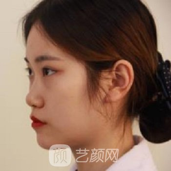 华人医联院黄文隆鼻实例，一下子就变成了精致的猪猪女孩
