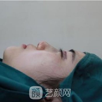 华人医联院黄文隆鼻实例，一下子就变成了精致的猪猪女孩