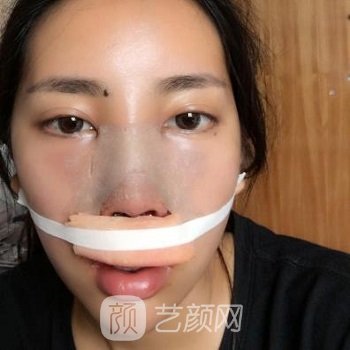 张世民隆鼻实例，术后不夸张，也不突兀，超协调