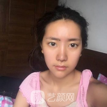 张世民隆鼻实例，术后不夸张，也不突兀，超协调