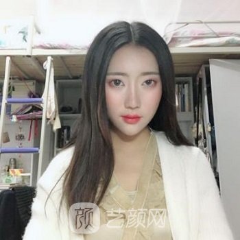 张世民隆鼻实例，术后不夸张，也不突兀，超协调