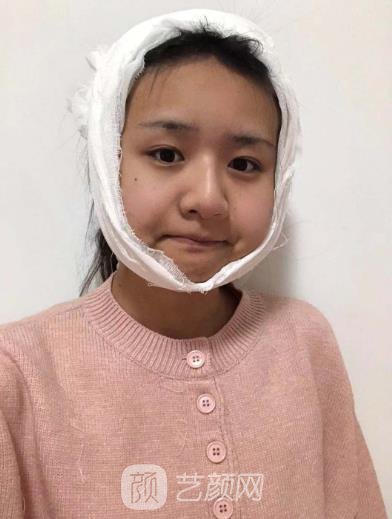 郑康在磨骨实例，手术前后对比差别大，拥有精致小脸
