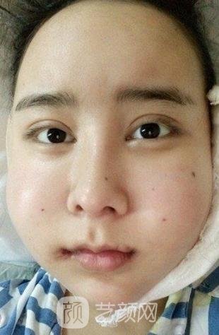 何晋龙磨骨修下颌角实例，术后拥有精致脸型，成为人群中焦点