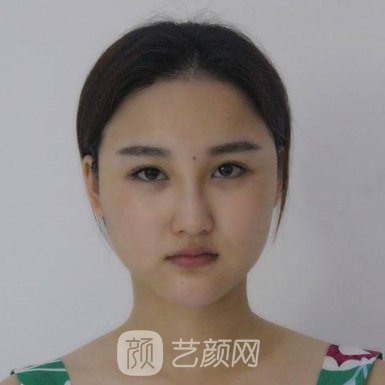 宁波薇琳医美医院是三甲医院吗?2023隆鼻实例出炉