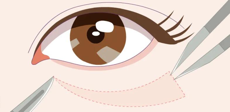 去眼袋动漫12.jpg 去眼袋动漫12.jpg