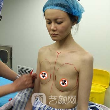 夏国兴隆胸实例，术后可以驾驭各种美丽性感的衣服！