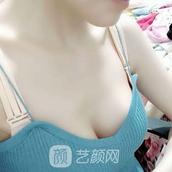 夏国兴隆胸实例，术后可以驾驭各种美丽性感的衣服！
