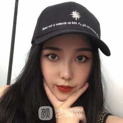 长春铭医整形双眼皮整形风格公开|成果自然无痕
