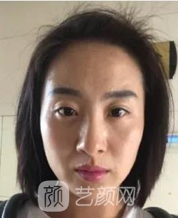 八大处拉皮骨干医生名单介绍|口碑评价|拉皮除皱实例对比图