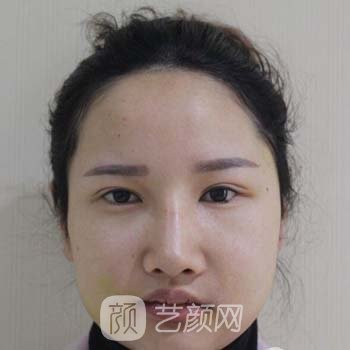 北京八大处张智勇做颧骨颧弓内推怎么样？医生介绍+实例