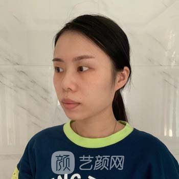 广东韩妃做双眼皮怎么样？多少钱？骨干医生介绍+双眼皮实例