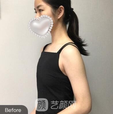 沈正宇隆胸实例，简直成为迷人的妖精，凹凸有致