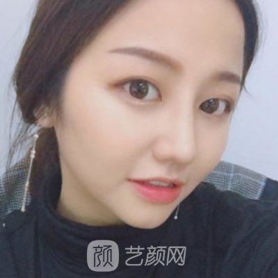 北京颐美佳中医院整形科隆鼻实例展示|附体验对比图