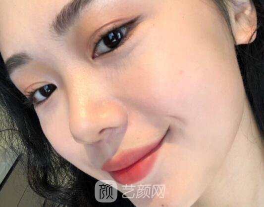 北京聚美仕不开刀去眼袋手术实例公开｜附体验对比图