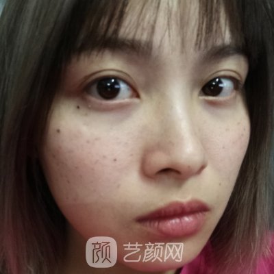 广美整形美容医院点阵激光实例曝光|成果自然无痕