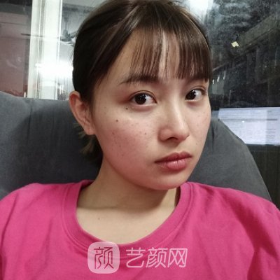 广美整形美容医院点阵激光实例曝光|成果自然无痕