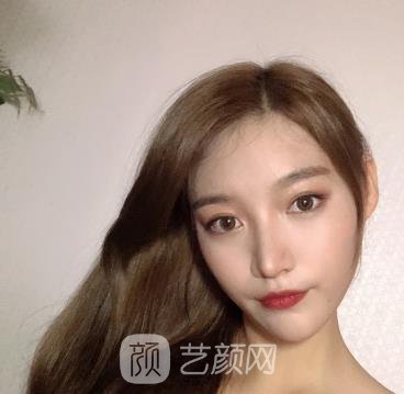 华西整形科卿勇隆鼻实例，鼻子看上去小巧精致，弧度特别优美