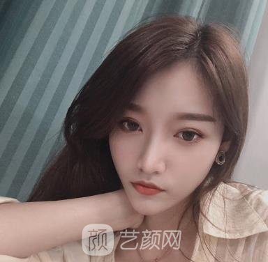 华西整形科卿勇隆鼻实例，鼻子看上去小巧精致，弧度特别优美