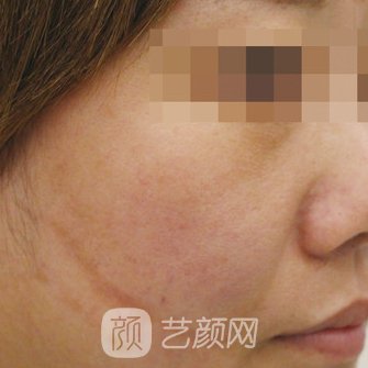 江西省儿童医院整形科怎么样?2023疤痕修复实例一览