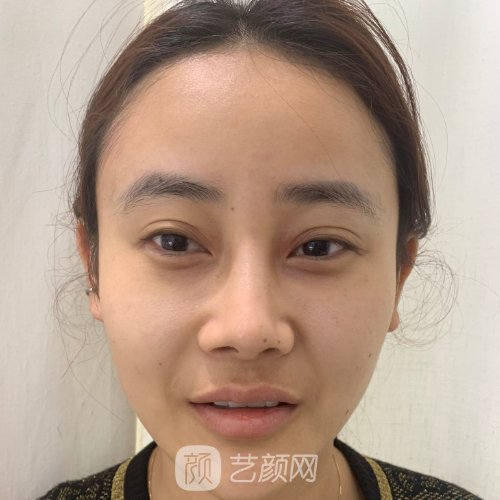 魏亨坤隆鼻修复好吗?医生实力及实例出炉