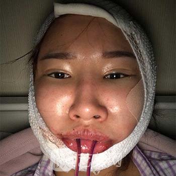 卢丙仑磨骨颧骨实例，术后面相得到了改变，年轻好多