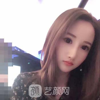 卢丙仑磨骨颧骨实例，术后面相得到了改变，年轻好多