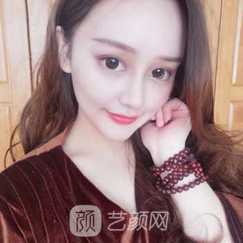 艺龄魏红军隆鼻实例，鼻子自然美观，基本没有手术痕迹